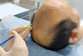 CGF 治疗脱发靠谱吗？青穗植发详解第三代自体毛囊再生技术