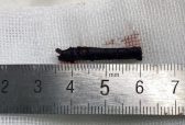 福建老人左眼被戳伤反复感染十天跨省赴昌求医 南昌爱尔专家取出2.5厘米眶内异物