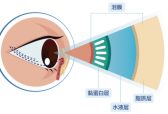 关于近视手术和干眼，为什么有人顺利摘镜，有人却被劝退？